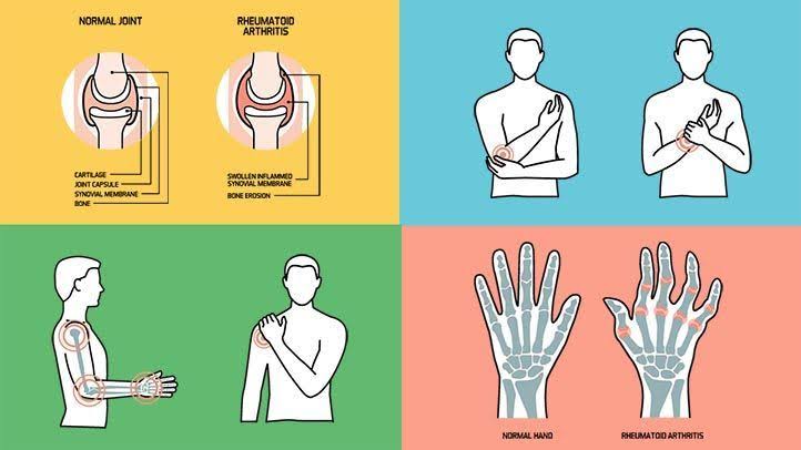 Rheumatoid Arthritis Awareness Day: Raising Awareness for a Silent Disease